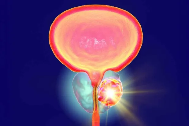 تطويرات متواصلة لاختبارات الكشف عن سرطان البروستاتا