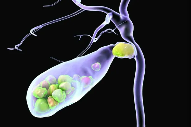 حصى المرارة... كيف تتكون وما طرق تشخيصها؟