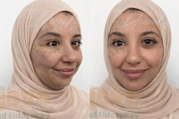 صورتان لآية سلامة بعد عمليات التجميل في مصر (الطبيب المعالج)