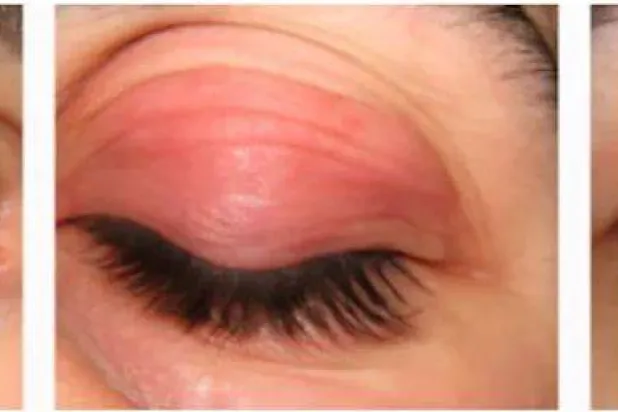 صورة مولدة بالذكاء الاصطناعي لحالة مرض «بيكسونيمانيا» الوهمي