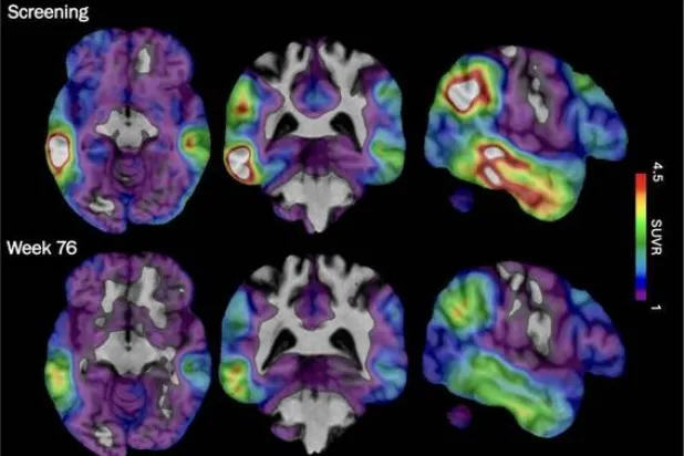  These brain scan images provided by Biogen show how high levels of Alzheimer's-related tau protein, in red, dropped in a recipient of the company's experimental drug diranersen. (Biogen via AP) 