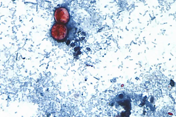 صورة مجهرية من مركز السيطرة على الأمراض (CDC) تُظهر طفيليات «السيكلوسبورا» في عينة براز مصبوغة بالسافرانين (أسوشيتد برس)