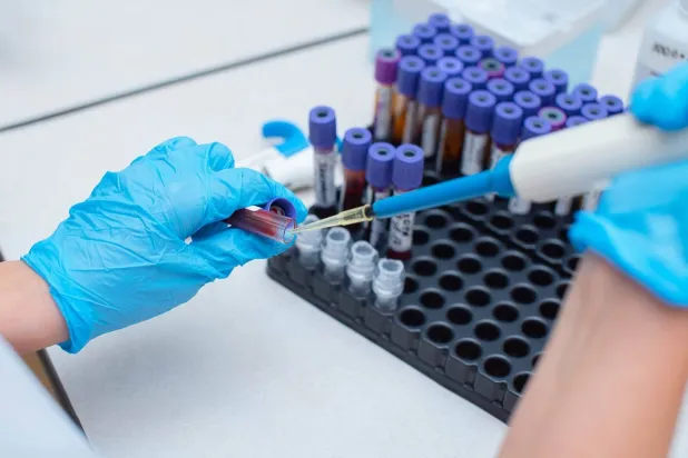 اختبار الدم الجديد مدعوم بالذكاء الاصطناعي لرصد سرطان الكبد بدقة (جامعة جونز هوبكنز)