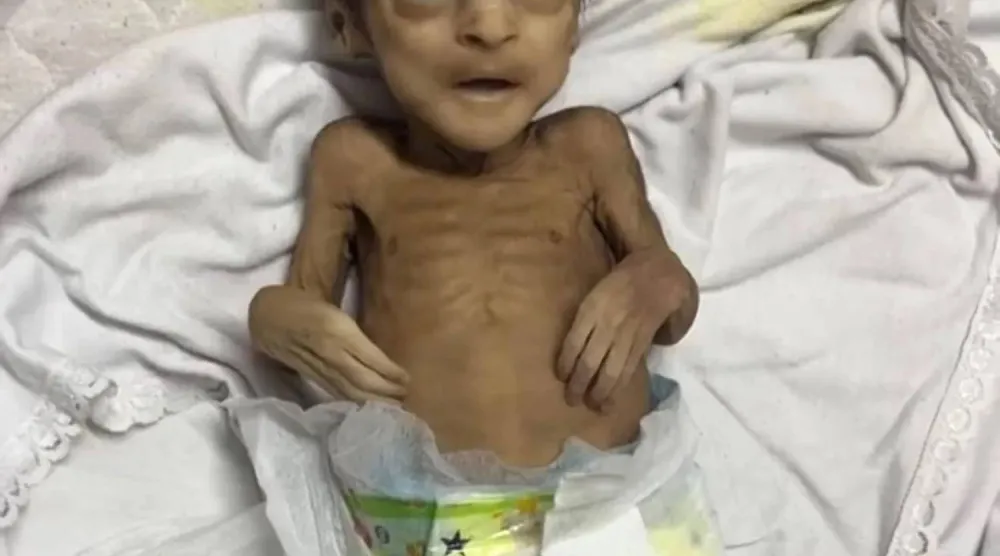 الطفل أحمد طليب الذي تُوفي نتيجة سوء التغذية والحصار الإسرائيلي على غزة (المركز الفلسطيني للإعلام)