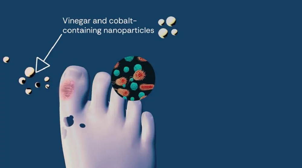 الباحثون أضافوا جزيئات نانوية مضادة للميكروبات رفعت من فاعلية الخل في علاج الجروح المزمنة (معهد كوينزلاند للأبحاث الطبية)