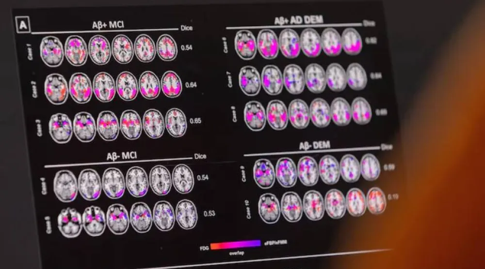 الخرف هو مجموعة من الاضطرابات الإدراكية التي تؤدي إلى تراجع في الذاكرة والتفكير والقدرات الذهنية الأخرى (أرشيفية - رويترز)