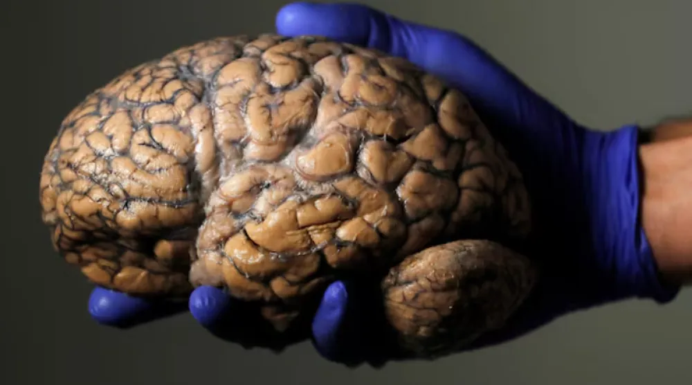A researcher holds a human brain, part of a collection of more than 3,000 brains at the psychiatric hospital in Duffel, Belgium, July 19, 2017. REUTERS/Yves Herman 