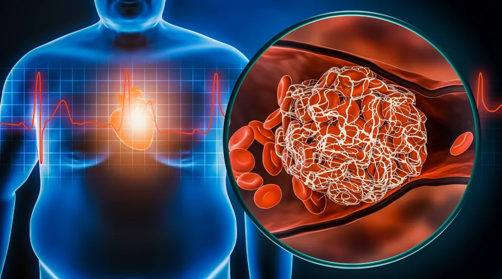 طفرة جينية تغيّر فهمنا لعلاقة السمنة بأمراض القلب