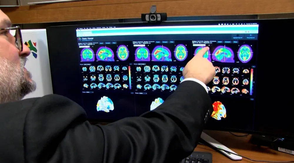 ألزهايمر يؤدي لتراكم بروتينات في الدماغ تسبب تلف الخلايا العصبية وفقدان الوظائف العقلية (مايو كلينك)