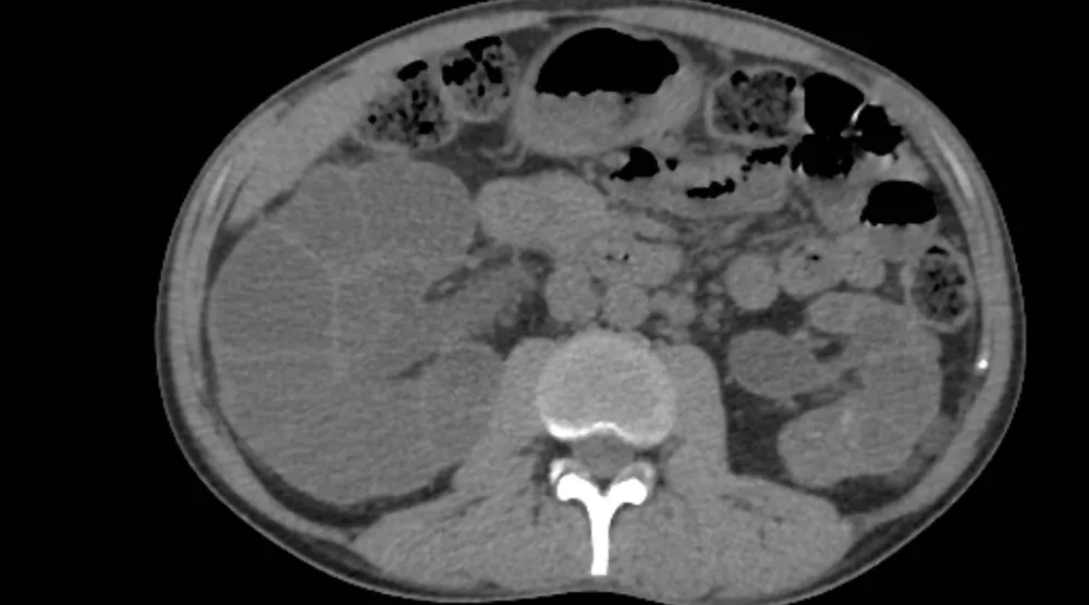 تصوير مقطعي محوسب لكلية مصابة بالتكيسات والحصى