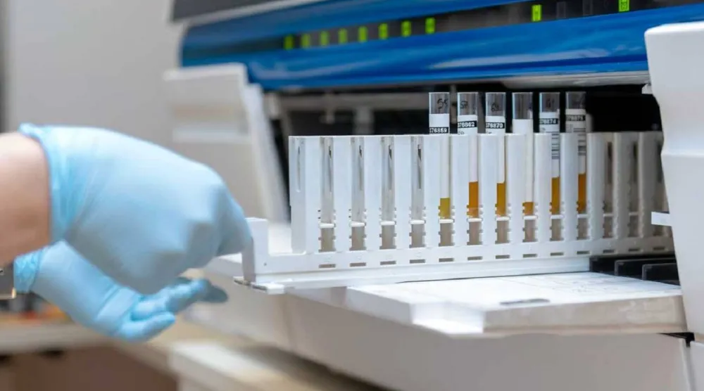 الفحص الجديد يعتمد على عينة بول لتشخيص سرطان المثانة بدقة (مركز موفيت للسرطان في أميركا)