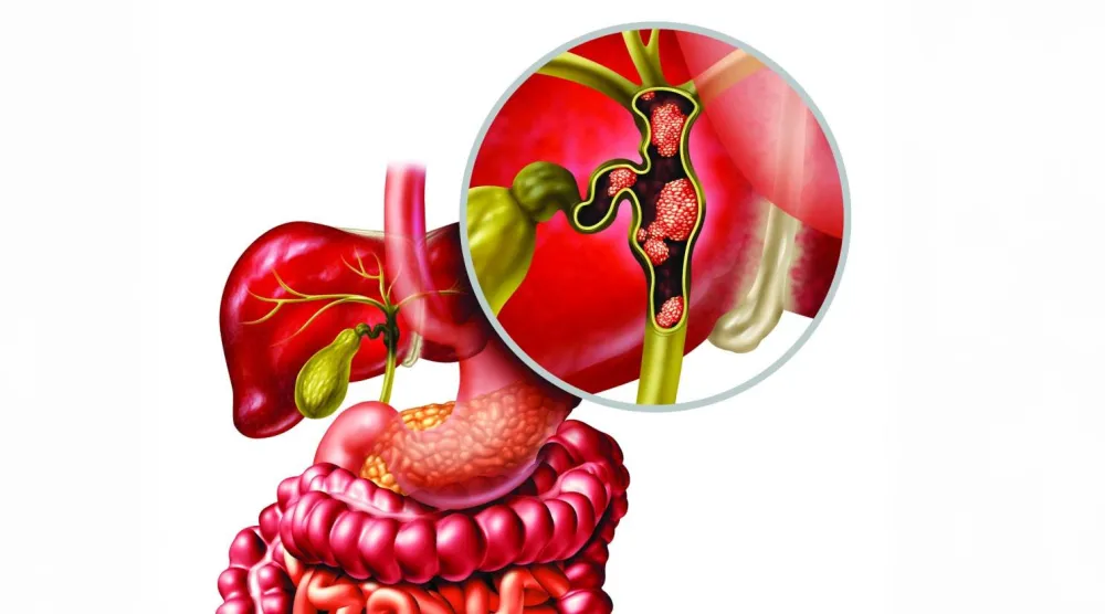 مسار جديد لعلاج سرطان الكبد العدواني