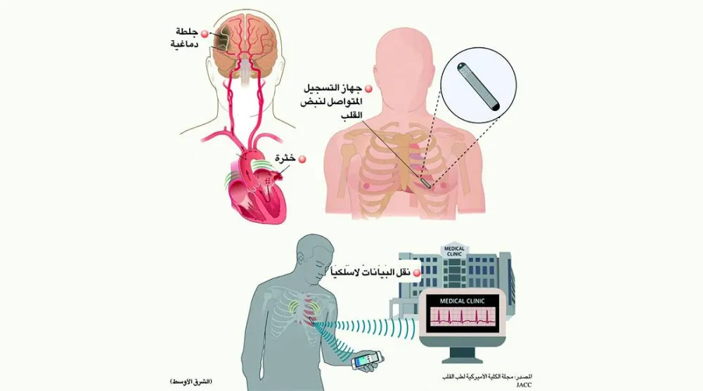 استشارات: مُسجِّل مزروع لرصد نبضات القلب - إزعاج غازات البطن