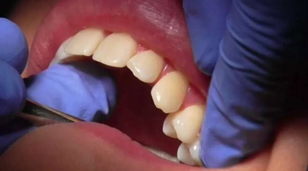 «اختراق وتعطيل» قنوات التواصل بين الميكروبات في الفم قد يعزز مستويات البكتيريا النافعة ويقي من التسوس (رويترز)