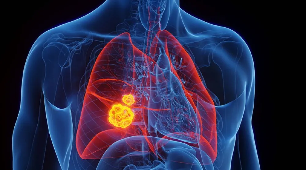 سرطان الرئة يتميز بسرعة نموه وانتشاره إلى أعضاء أخرى في الجسم (جامعة ميامي)