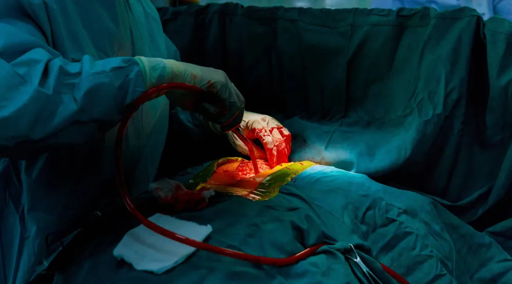 أرشيفية لفريق من الجراحين خلال جراحة القلب والأوعية الدموية (الشرق الأوسط)