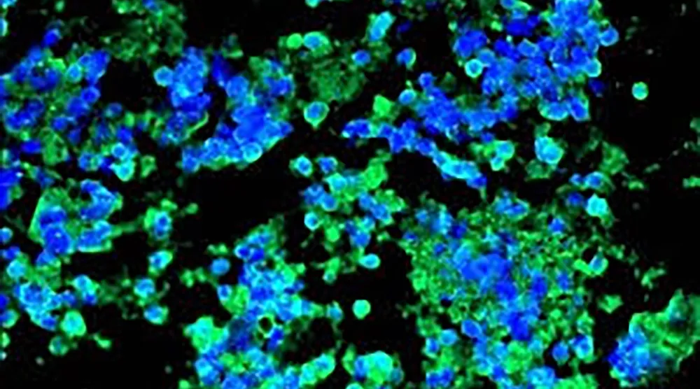 صورة من مختبر الباحث إدوارد باتز تظهر فيها نوى الخلايا السرطانية في الرئة باللون الأزرق وهي ترتبط بالأجسام المضادة «جي تي 103» باللون الأخضر