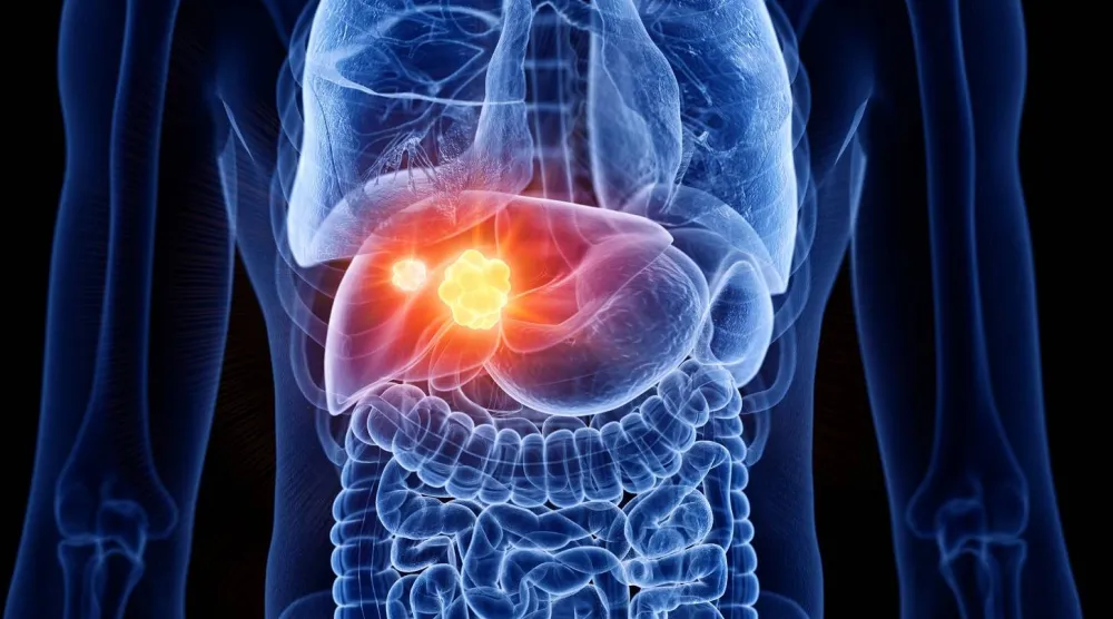 سرطان الكبد من أكثر أنواع السرطان خطورة وانتشاراً في العالم (جامعة فلوريدا)