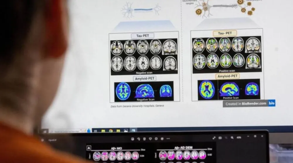 اختبار بسيط قد يتنبأ بأعراض «ألزهايمر» قبل سنوات