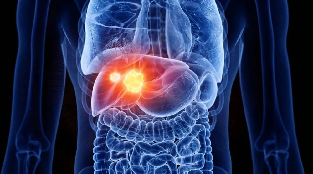 سرطان الكبد من أكثر أنواع السرطان خطورة وانتشاراً في العالم (جامعة فلوريدا)