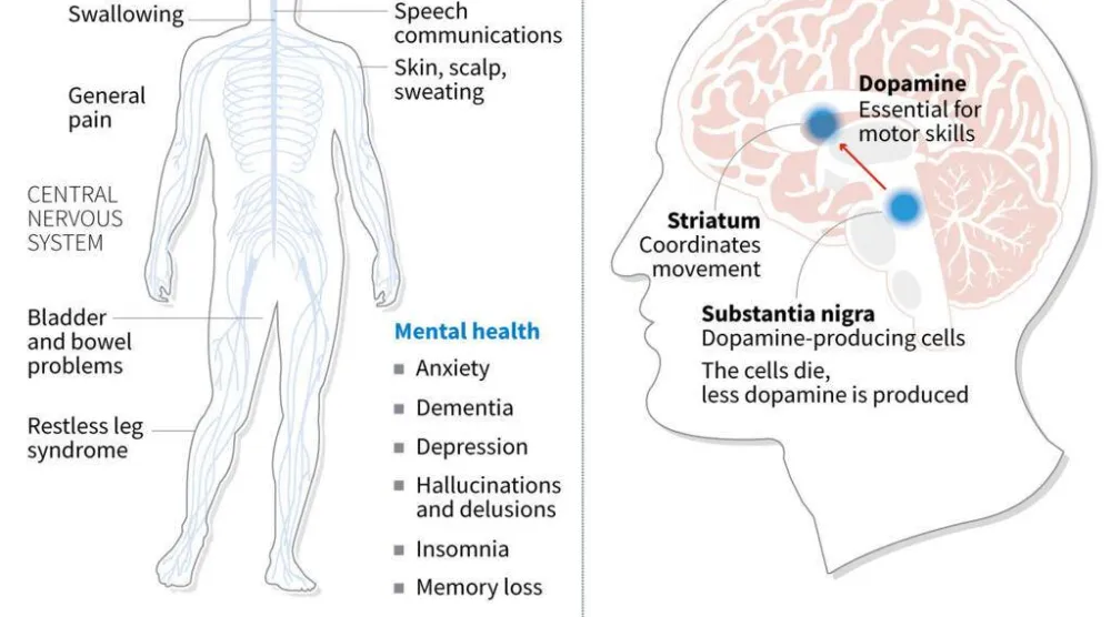 Parkinson's disease. John SAEKI, Adrian LEUNG / AFP
