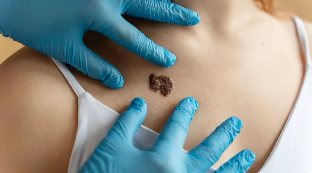 دراسة أسترالية تتوقع انخفاض معدل الإصابة بسرطان الجلد بين الأطفال