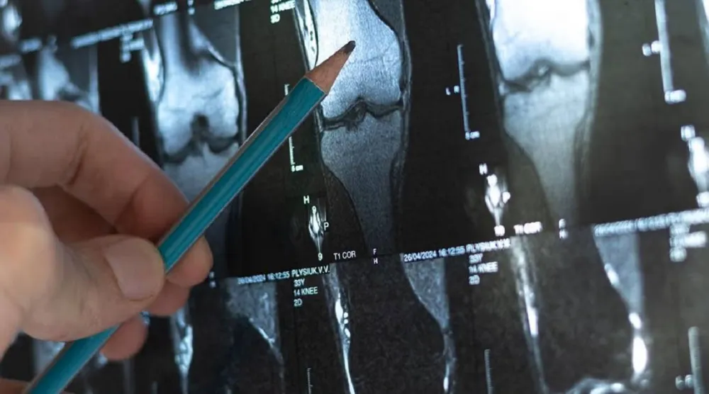 سرطان العظام يظهر عادة في الأطراف مثل عظام الساق (جامعة كيس ويسترن ريزيرف)