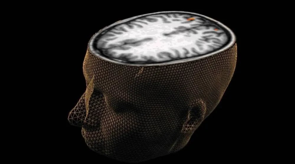 الأدوية المتوفرة حالياً لا تحسن المشكلات الإدراكية مثل التفكير غير المنظم (رويترز)