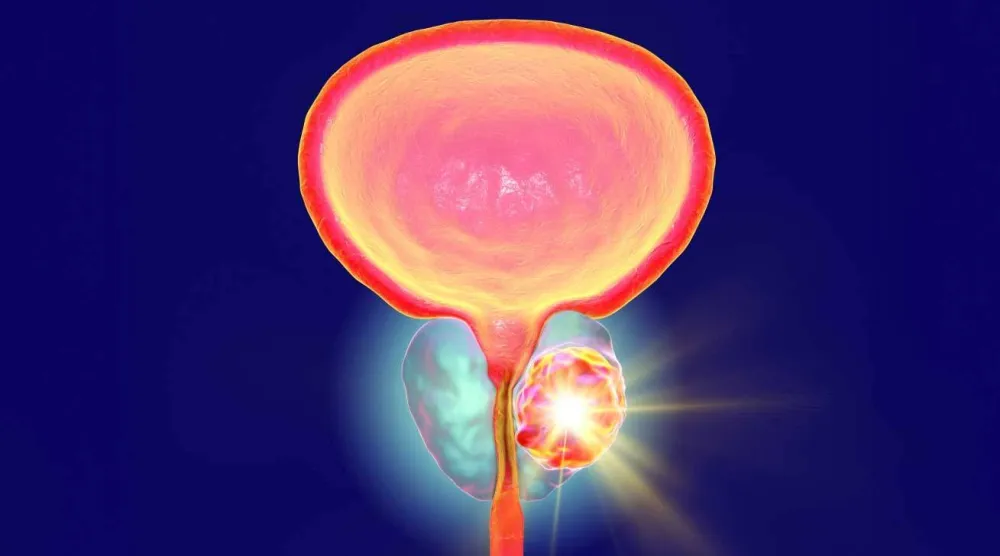 تطويرات متواصلة لاختبارات الكشف عن سرطان البروستاتا