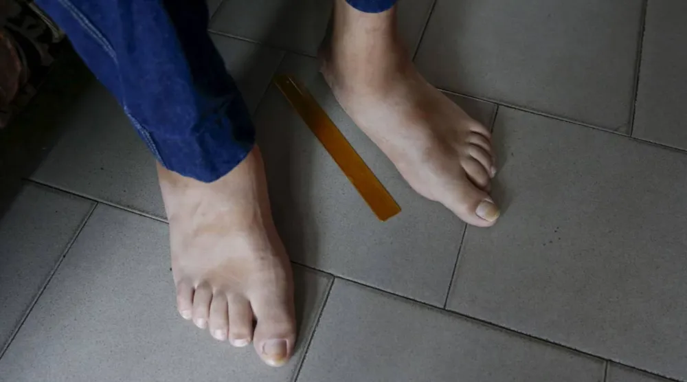 قد يكون التورم مؤقتاً وطبيعياً مثل الحالات الناتجة عن الوقوف الطويل (أرشيفية-رويترز)