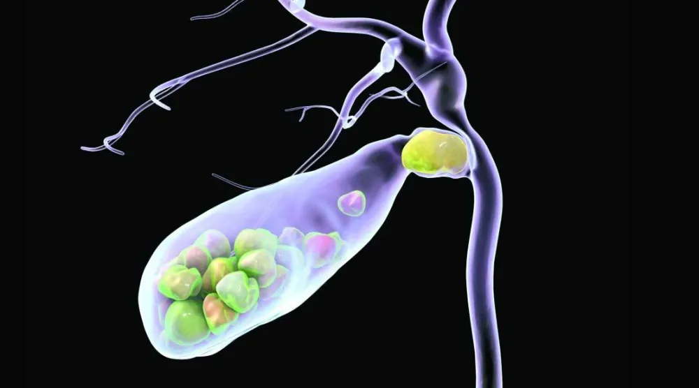 حصى المرارة... كيف تتكون وما طرق تشخيصها؟