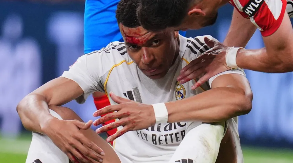 مبابي تعرض لإصابة في الرأس خلال المواجهة (أ.ب)