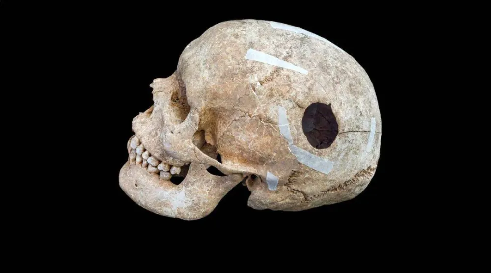 عُثر على جمجمة مثقوبة داخل حصن تل يعود إلى العصر الحديدي في واندلبوري (Cambridge Archaeological Unit)