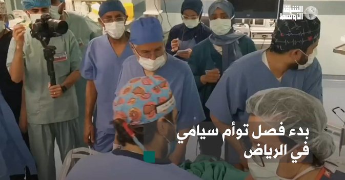 انطلاق عملية فصل التوأم النيجيري السيامي حسانة وحسينة في الرياض