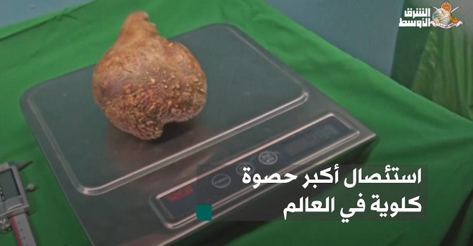استئصال أكبر حصوة كلوية في العالم