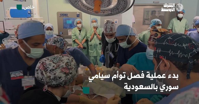 بدء عملية فصل توأم سيامي سوري بالسعودية