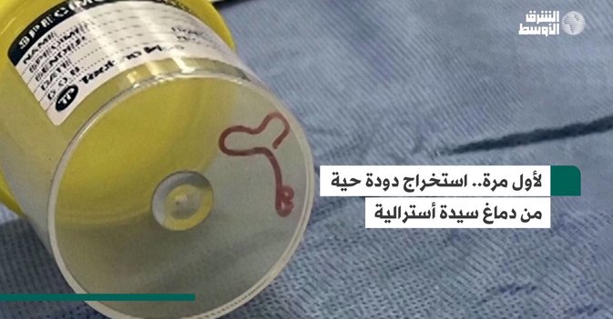 لأول مرة... استخراج دودة حية من دماغ سيدة أسترالية