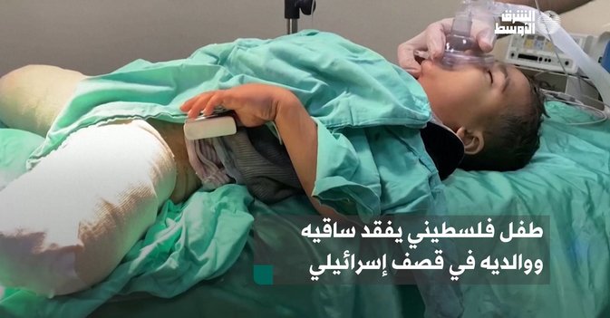 طفل فلسطيني يفقد ساقيه ووالديه في قصف إسرائيلي