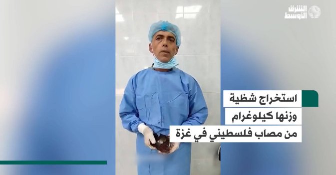 استخراج شظية وزنها كيلوغرام من مصاب فلسطيني في غزة