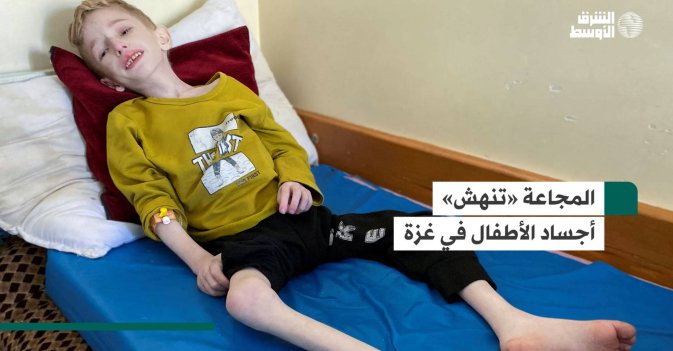 المجاعة «تنهش» أجساد الأطفال في غزة