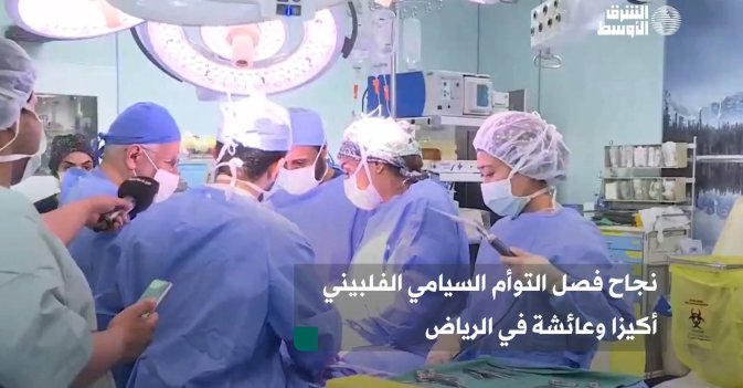 نجاح فصل التوأم السيامي الفلبيني أكيزا وعائشة في الرياض