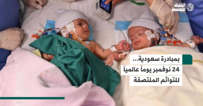 بمبادرة سعودية... 24 نوفمبر يوماً عالمياً للتوائم الملتصقة