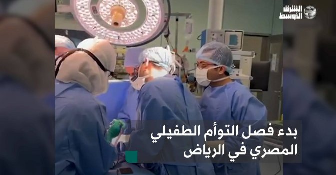 بدء فصل التوأم الطفيلي المصري في الرياض