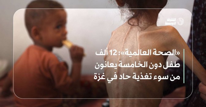 «الصحة العالمية»: 12 ألف طفل دون الخامسة يعانون من سوء تغذية حاد في غزة