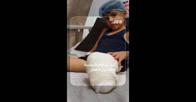 غزة.. بتر الأطراف وسيلة لإنقاذ أرواح الأطفال