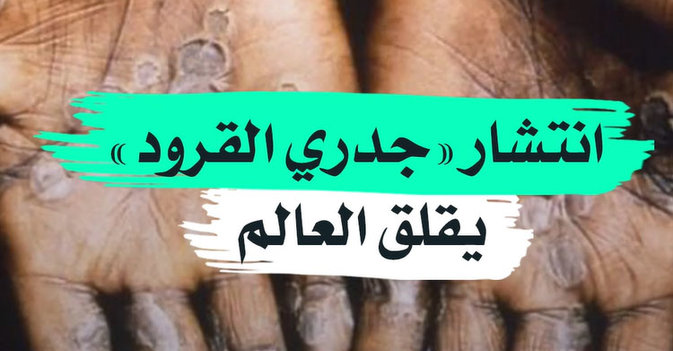 انتشار «جدري القرود» يقلق العالم