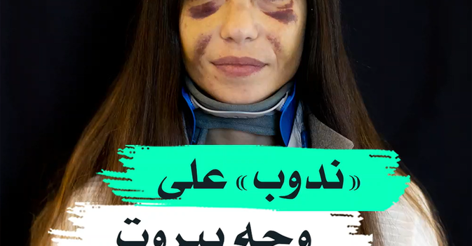 "ندوب" على وجه بيروت