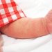 الإكزيما البنيوية وأحدث علاجاتها