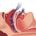 رسم توضيحي لانسداد عمليات التنفس في أثناء النوم (بابليك دومين)