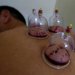 تعتمد الحجامة على مبدأ الشفط فتُوضع كؤوس على الجلد لإحداث ضغط سلبي يجذب الدم إلى السطح مما يعزز الدورة الدموية ويحفز عملية الشفاء (رويترز)